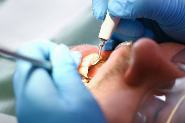 Best Emergency Wisdom Tooth Extraction in Omao, HI