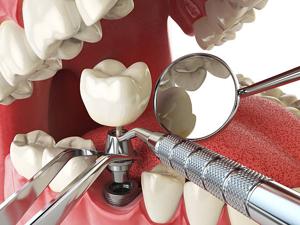 Best Broken or Chipped Tooth Repair in Omao, HI
